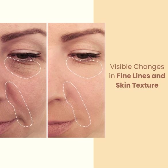Before and after comparison of fine lines and skin texture on a person's face. Face therapy device by Nasreen's Charms