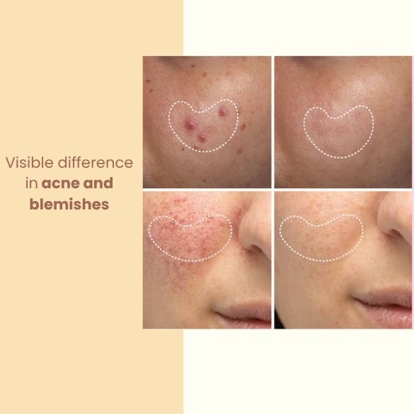 Collage of skin with acne and blemishes, showing a visible difference before and after treatment. Face therapy device by Nasreen's Charms
